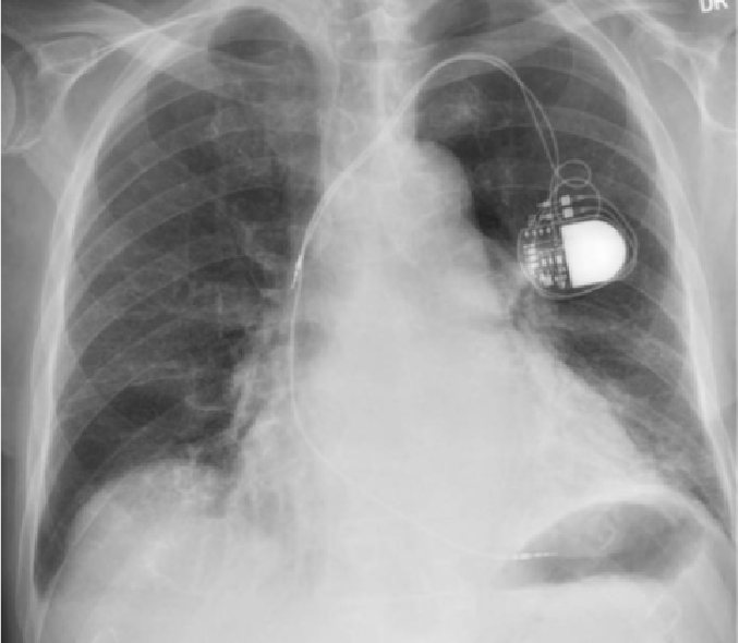 Chest x-ray results, Enlarged heart & pacemaker