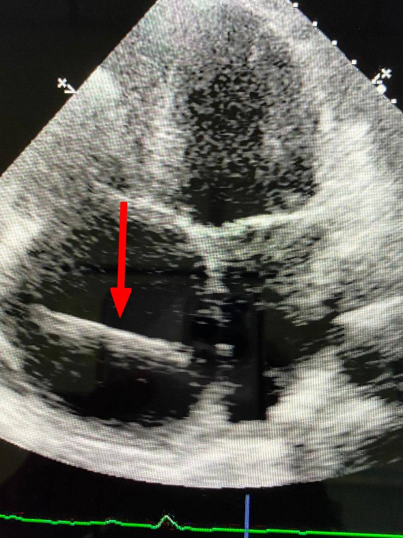 Enlarged Heart with defibrillator lead Echocardiography photo